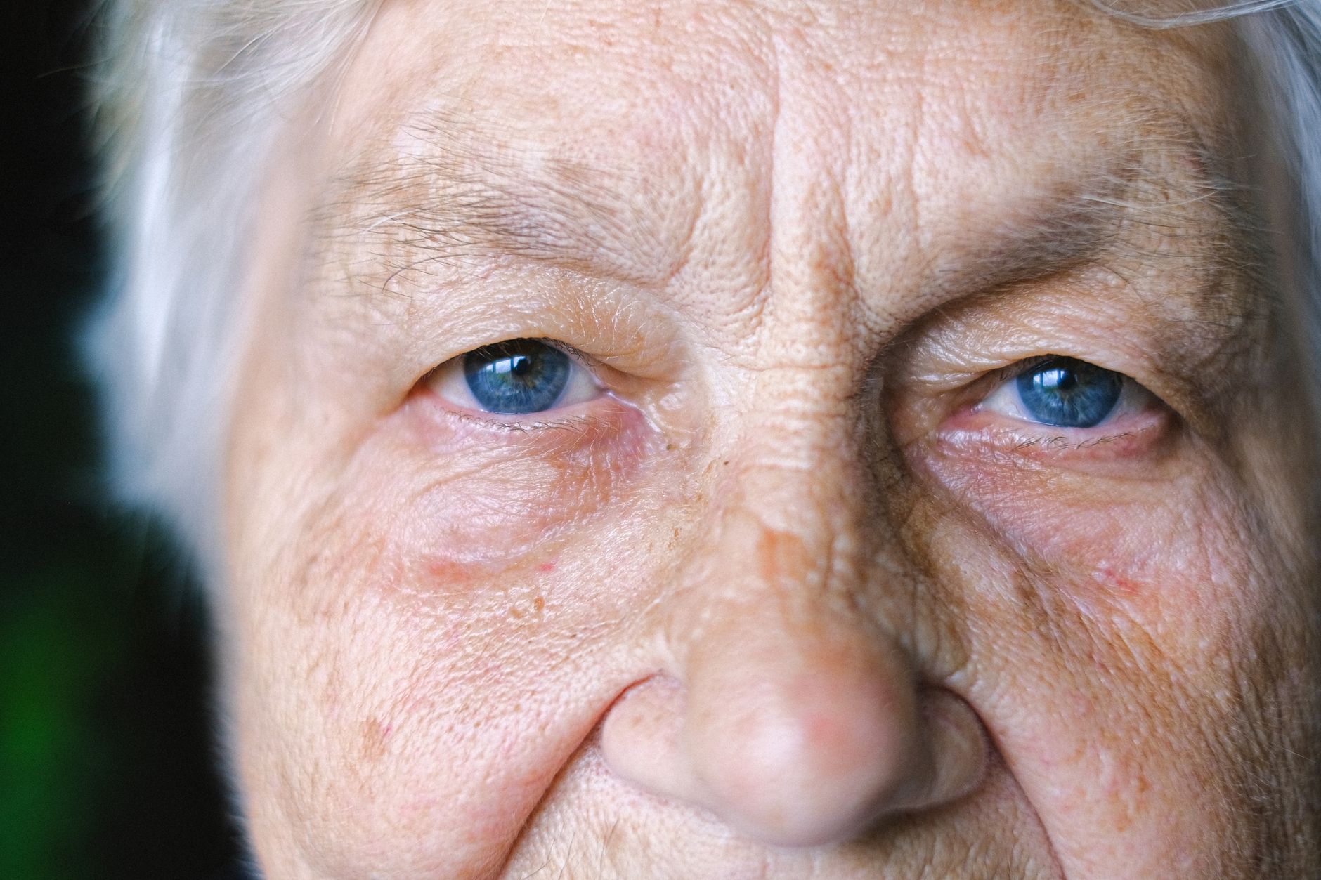 Can Reduced Blinking Be an Early Parkinson’s Sign?