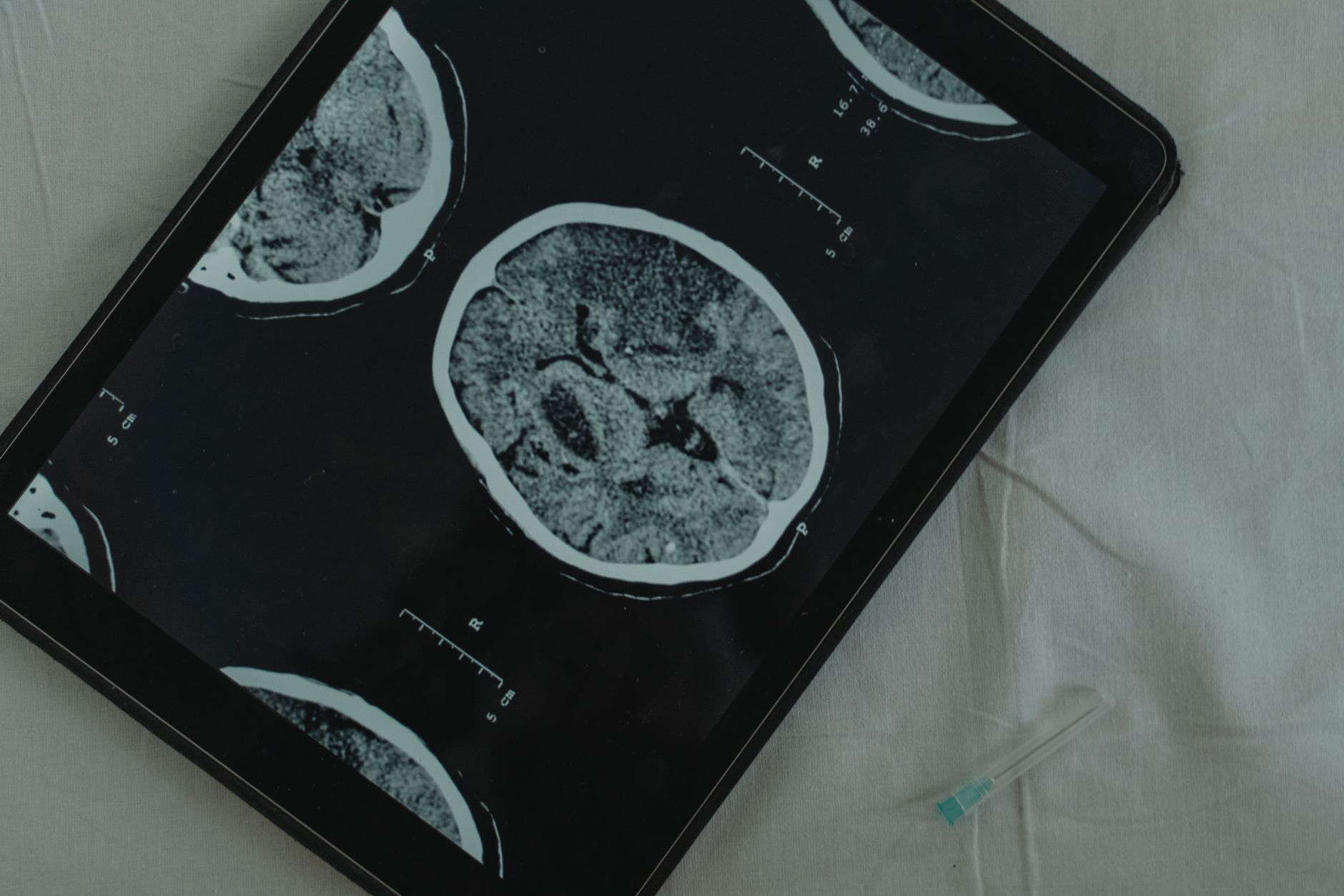 Deep brain stimulation treats severe Tourette syndrome effective results - Featured image