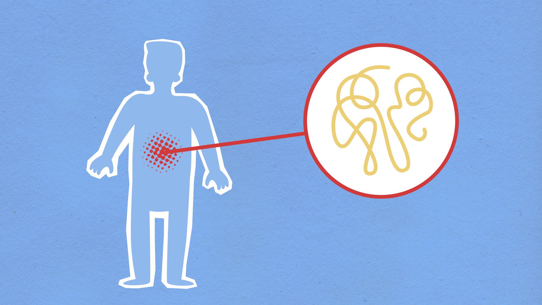 Gut microbiome dysfunction emerges as key Parkinson’s disease research focus