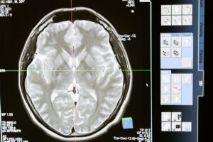 Parkinson's Brain Changes Before Motor Symptoms: What a New Two-Macaque Study Can Tell Us - Featured image