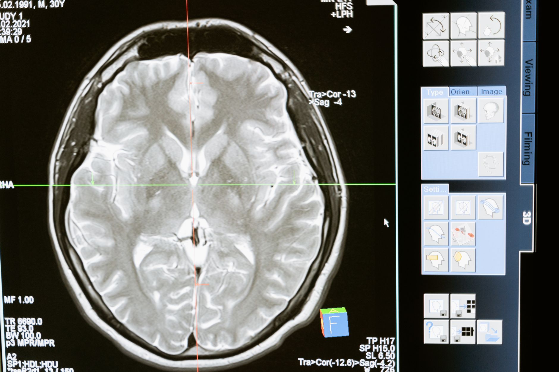 Parkinson's Brain Changes Before Motor Symptoms: What a New Two-Macaque Study Can Tell Us - Featured image