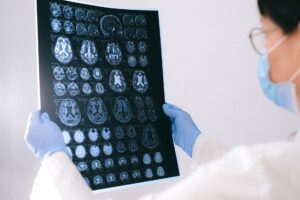 Deep Brain Stimulation Battery Replacement: What to Expect - Featured image